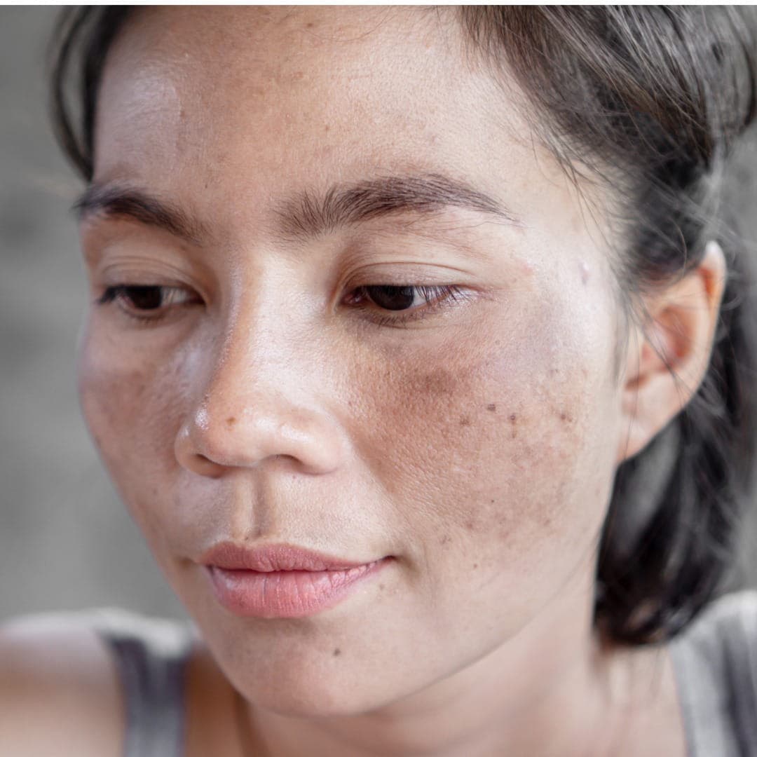 Dermatologist examining facial pigmentation for melasma diagnosis