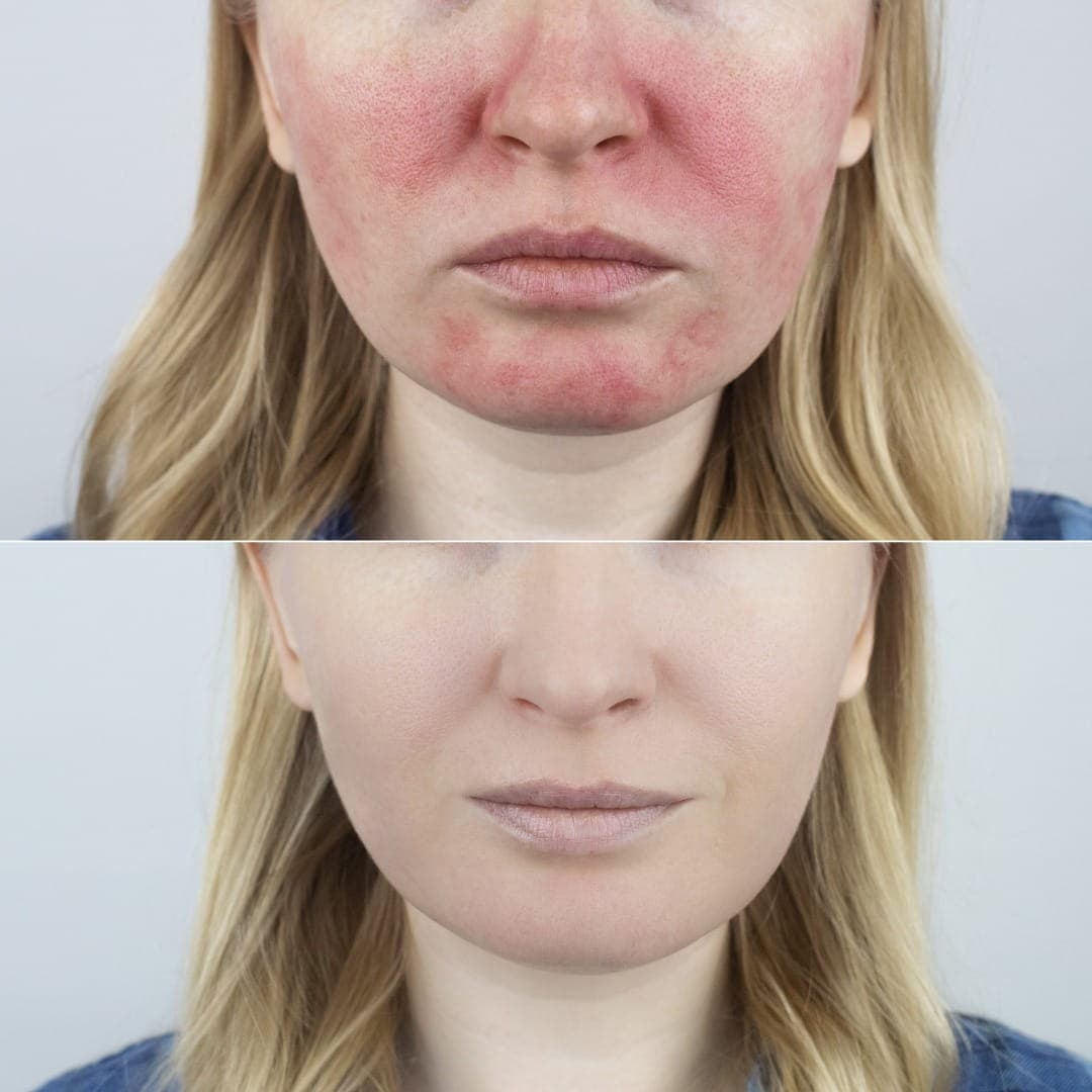 Rosacea Treatment Dubai — dermatologist consulting with patient