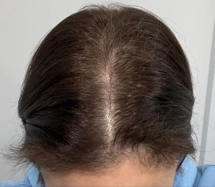 Stronger and healthier hair roots after therapy