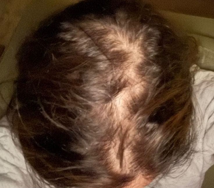Weak and brittle hair before treatment