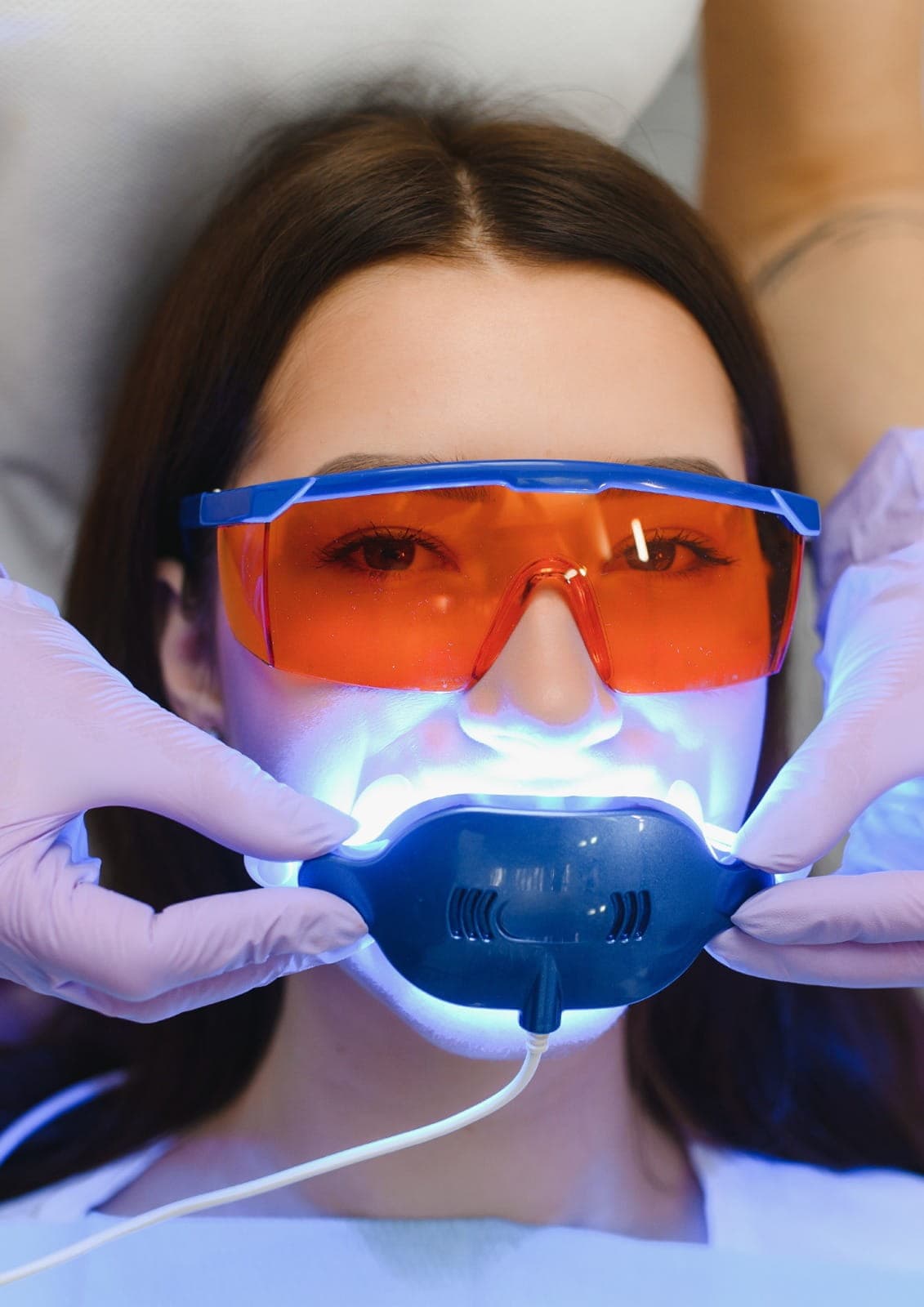 Laser bleaching in Dubai performed by specialists to reduce pigmentation and achieve a brighter, even skin tone.