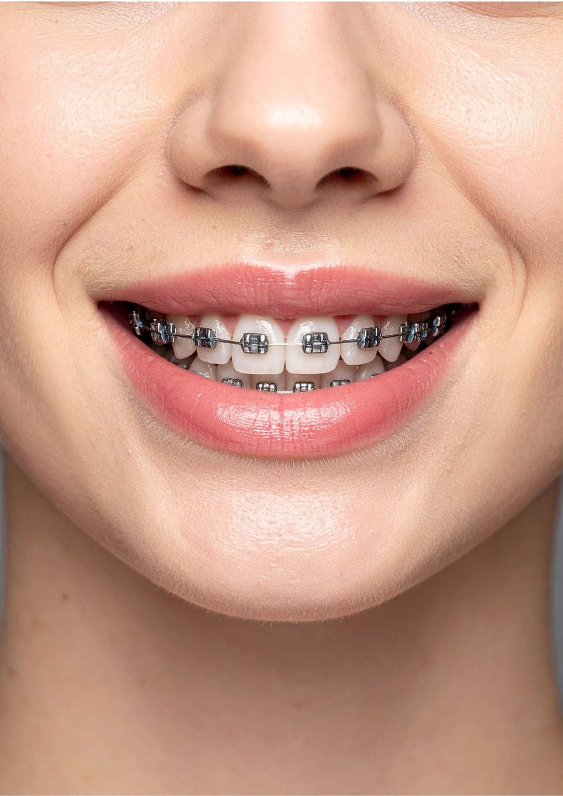 Braces (metal and ceramic) in Dubai are used to align teeth and improve bite for a healthier smile.