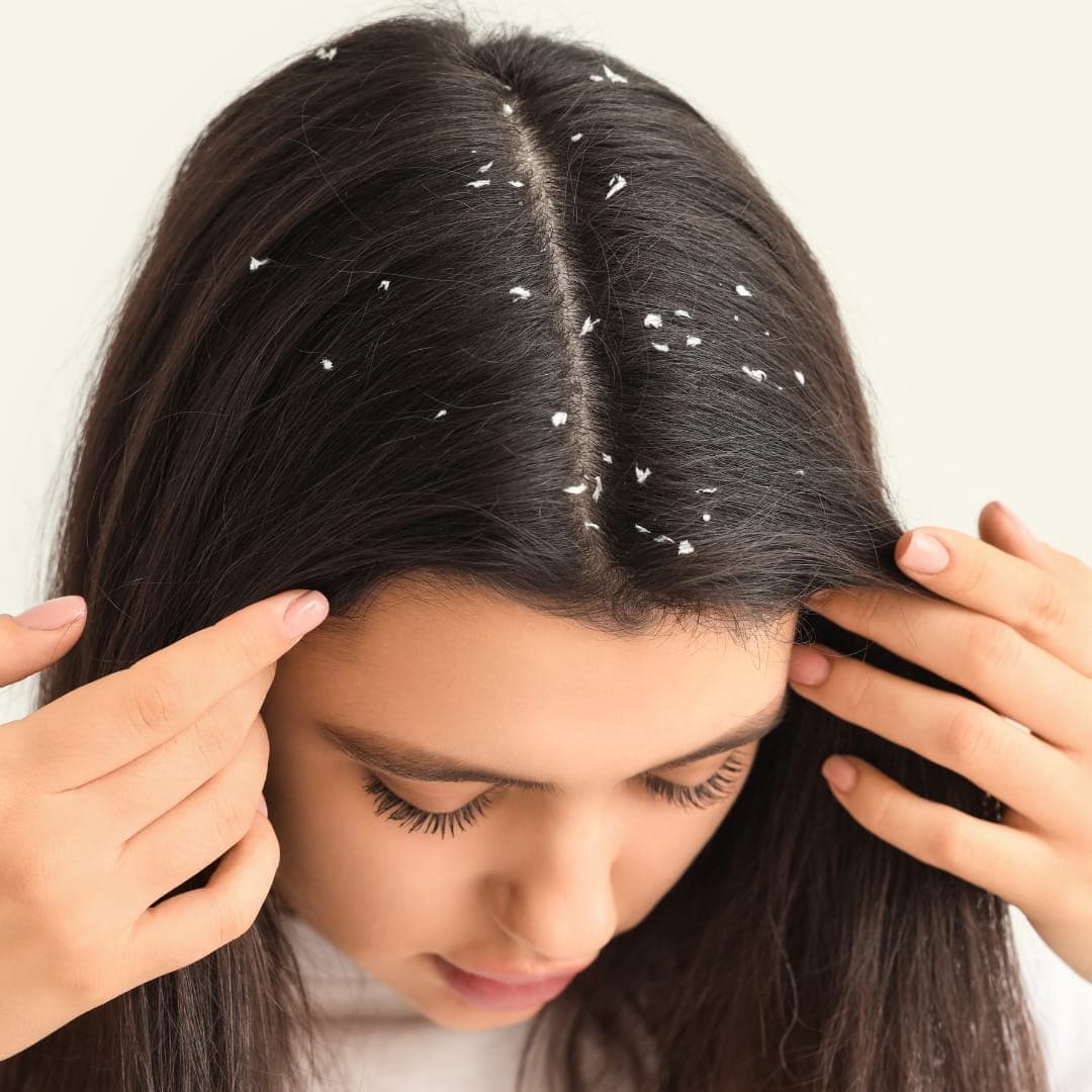 Dermatologist examining scalp for dandruff treatment Dubai consultation