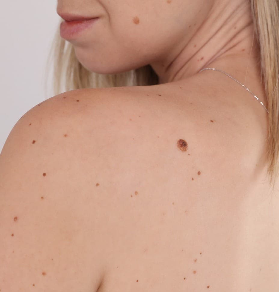Electrocautery skin tag removal treatment in Dubai