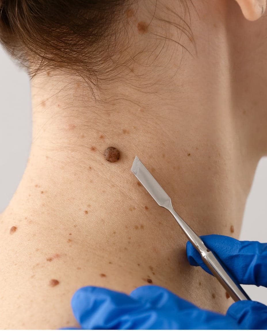 Skin Tag Removal in Dubai consultation at RamaCare Polyclinic