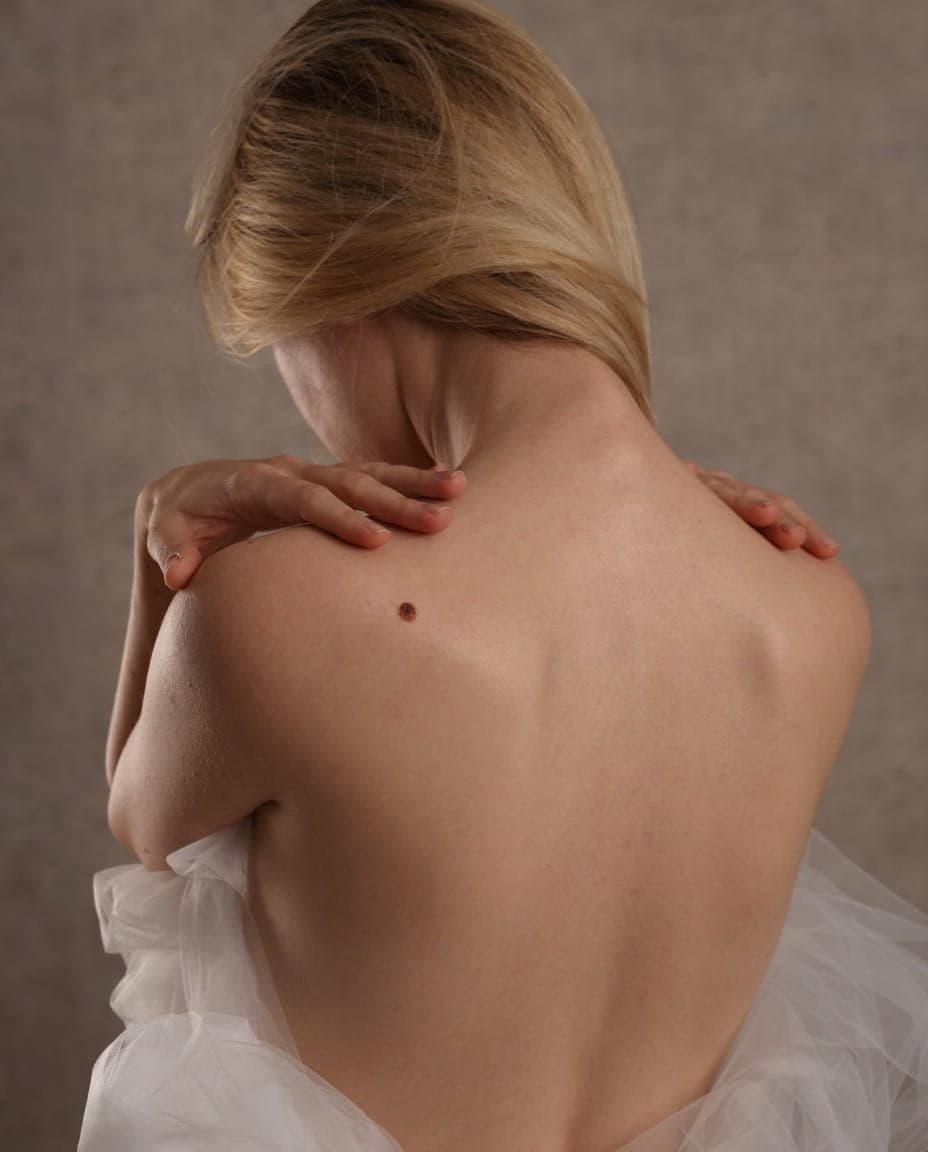 Book a skin tag removal consultation in Dubai at RamaCare