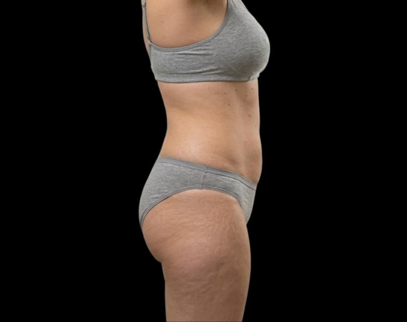 Eximia after treatment