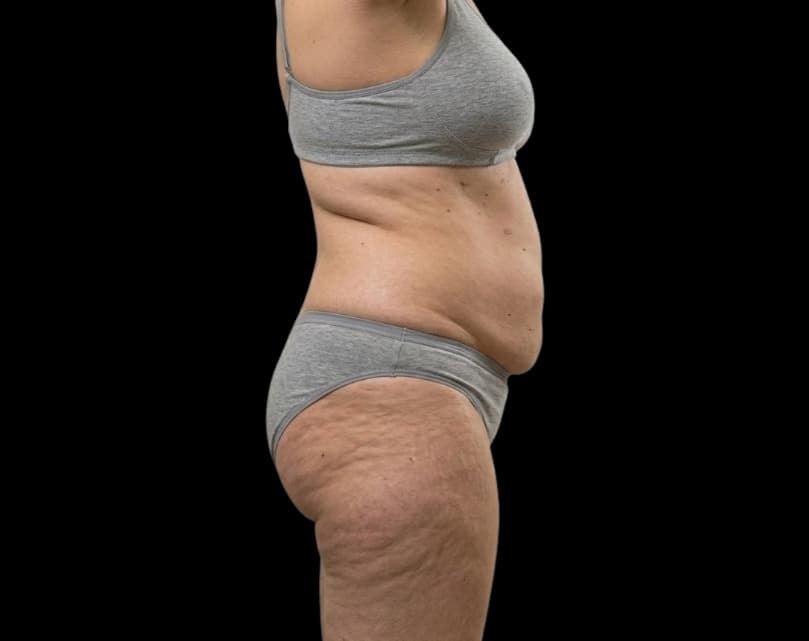 Eximia before treatment