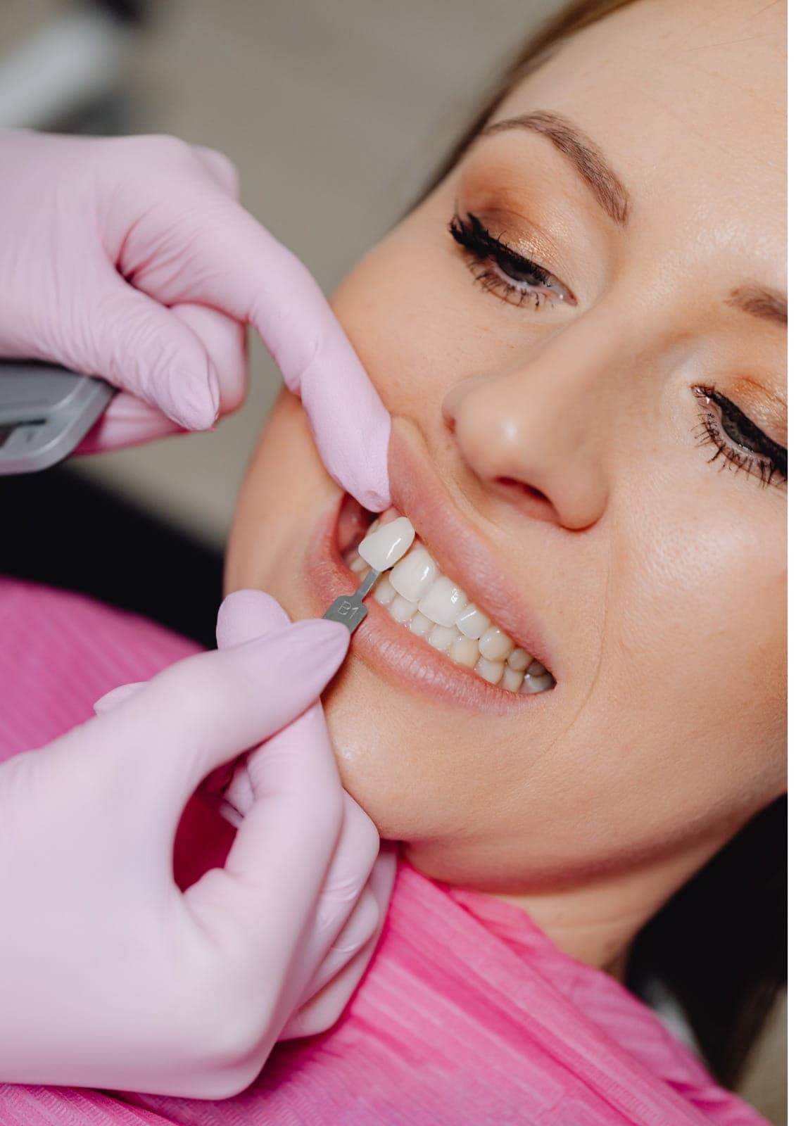 Composite veneers applied to enhance smile appearance with natural-looking results