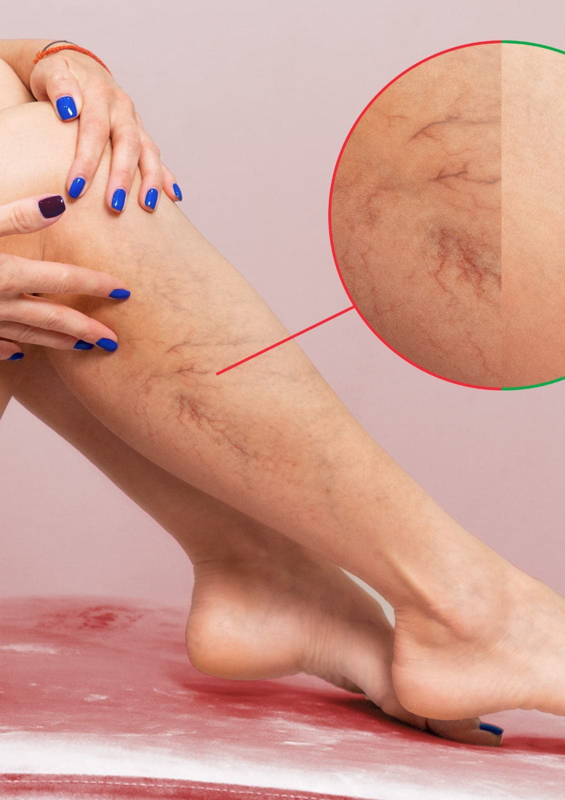 Spider veins laser treatment performed by specialists to reduce visible veins and improve skin appearance