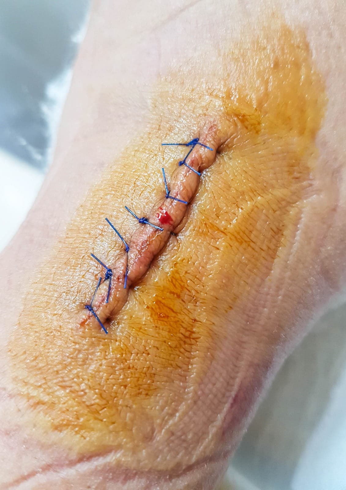 Wound stitching services performed by medical professionals in a sterile clinic environment for safe and effective healing.