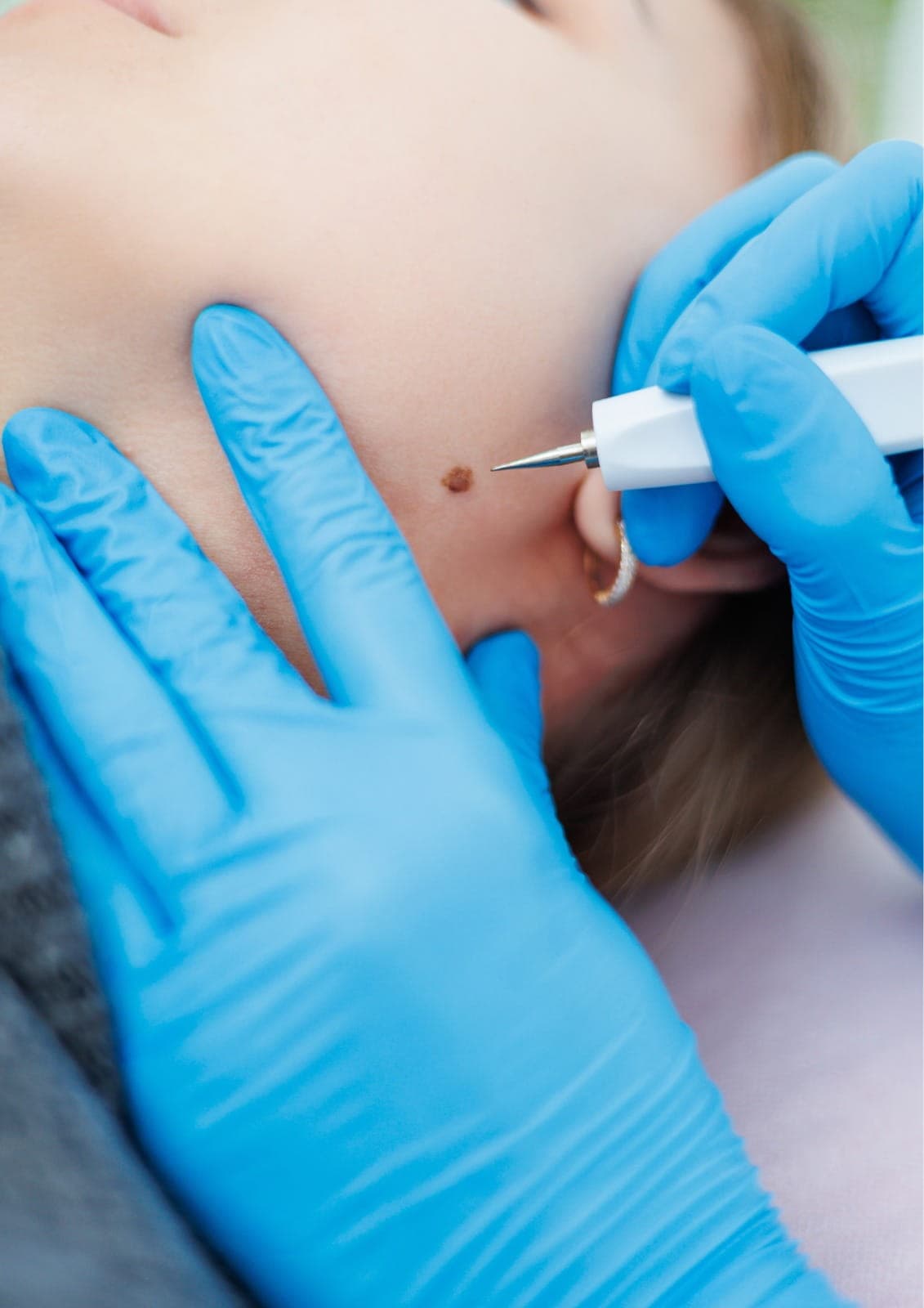 Birthmark removal in Dubai performed using advanced laser treatment by specialists to reduce pigmentation and improve skin appearance safely.