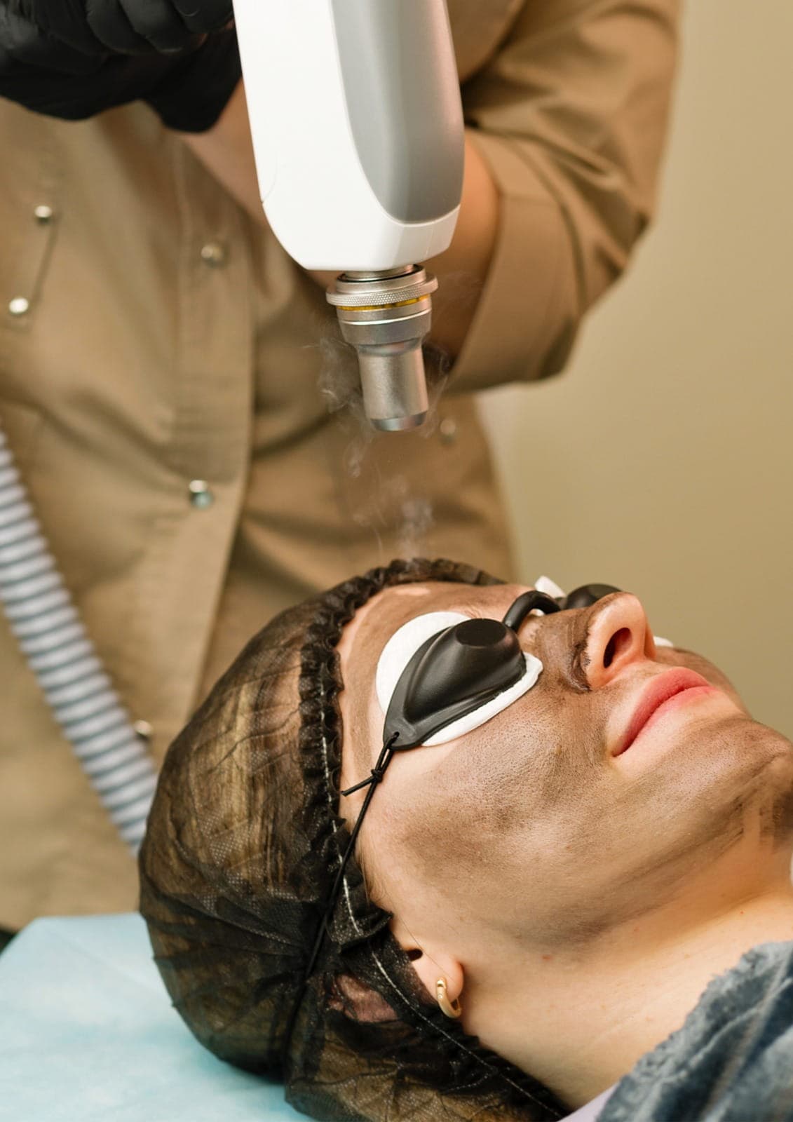 Carbon laser treatment performed by specialists to rejuvenate the skin, reduce pigmentation, and improve texture.