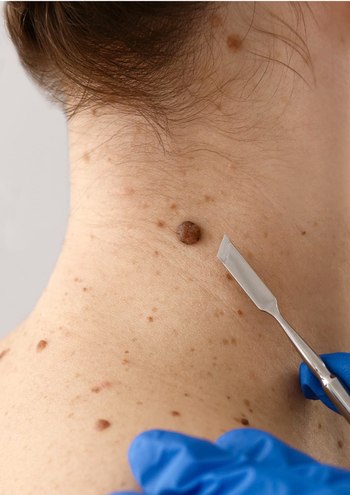 Mole removal in Dubai performed by specialists using safe and precise techniques to improve skin appearance.