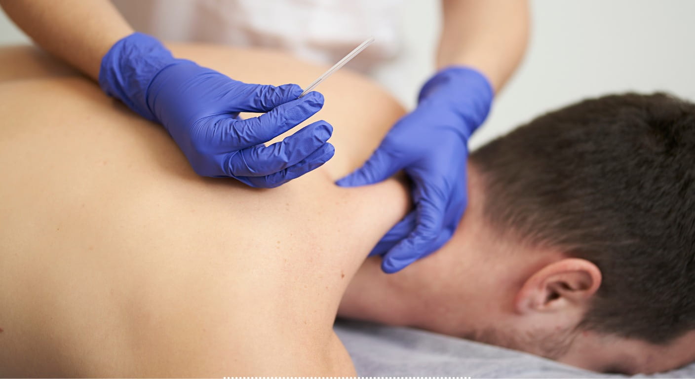 Physiotherapist performing dry needling treatment