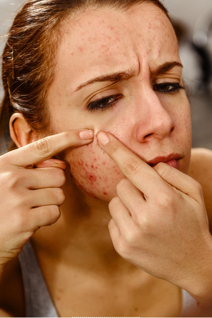 Acne Treatment in Dubai