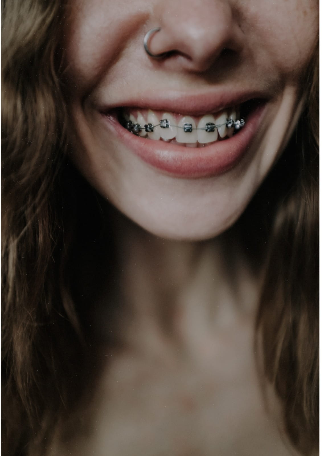 orthodontic braces alignment for smile makeover in Dubai