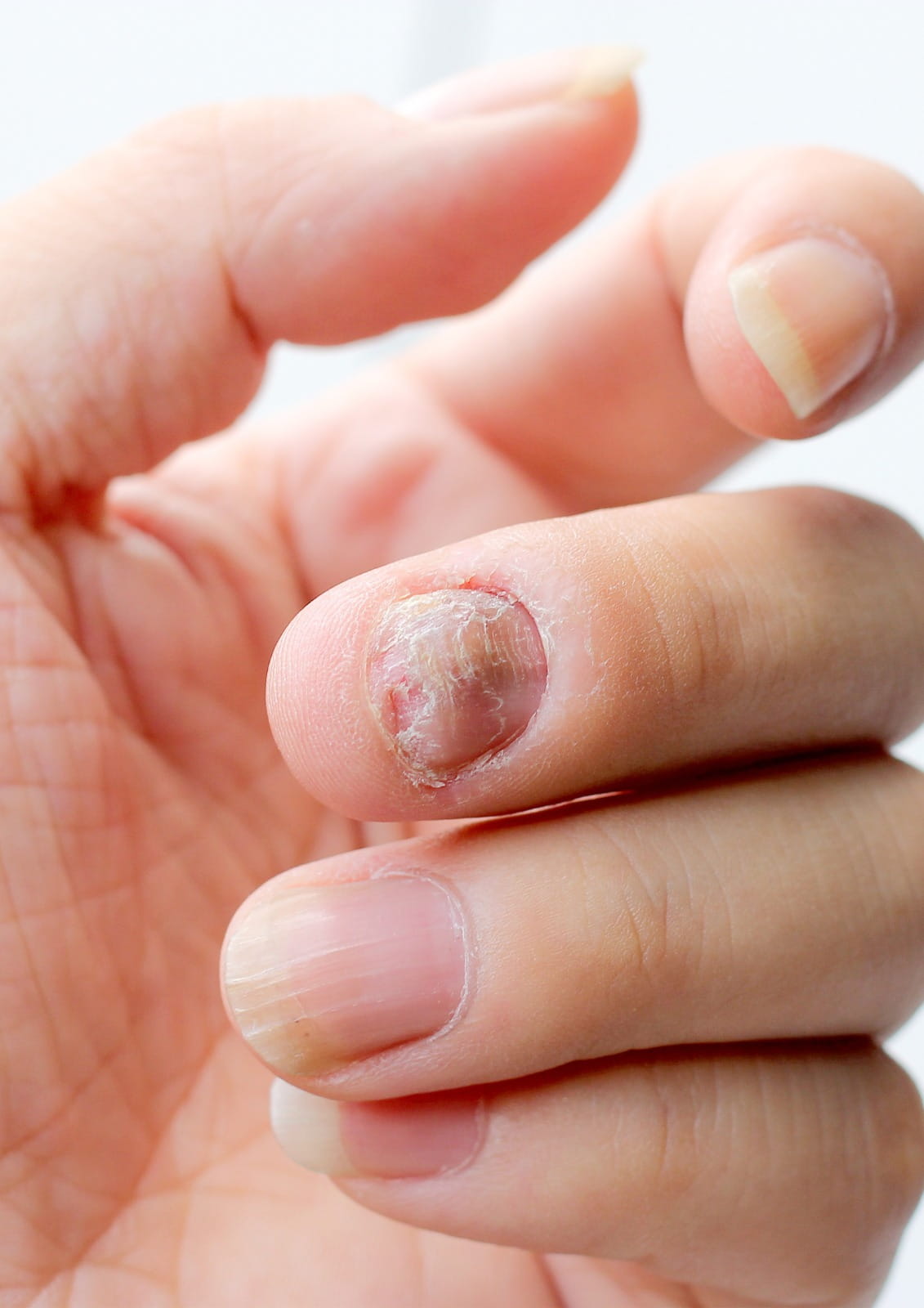 Nail fungus treatment in Dubai provided by specialists to restore healthy nails and prevent infection recurrence.