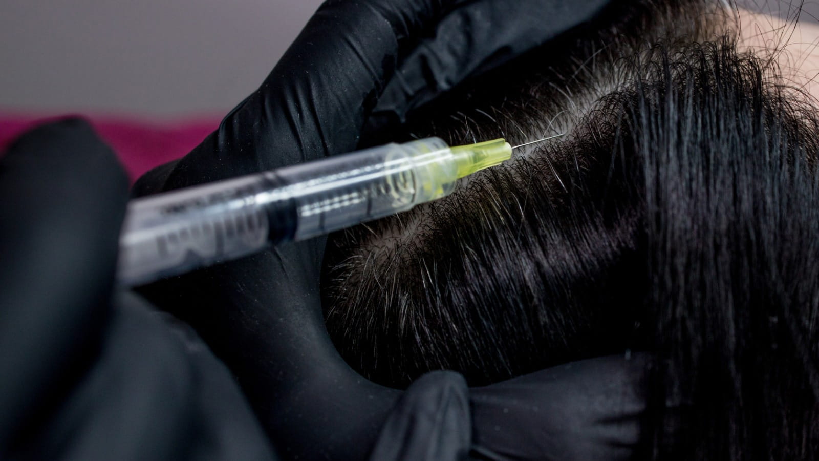 PRP hair treatment procedure for hair loss Dubai at RamaCare Polyclinic