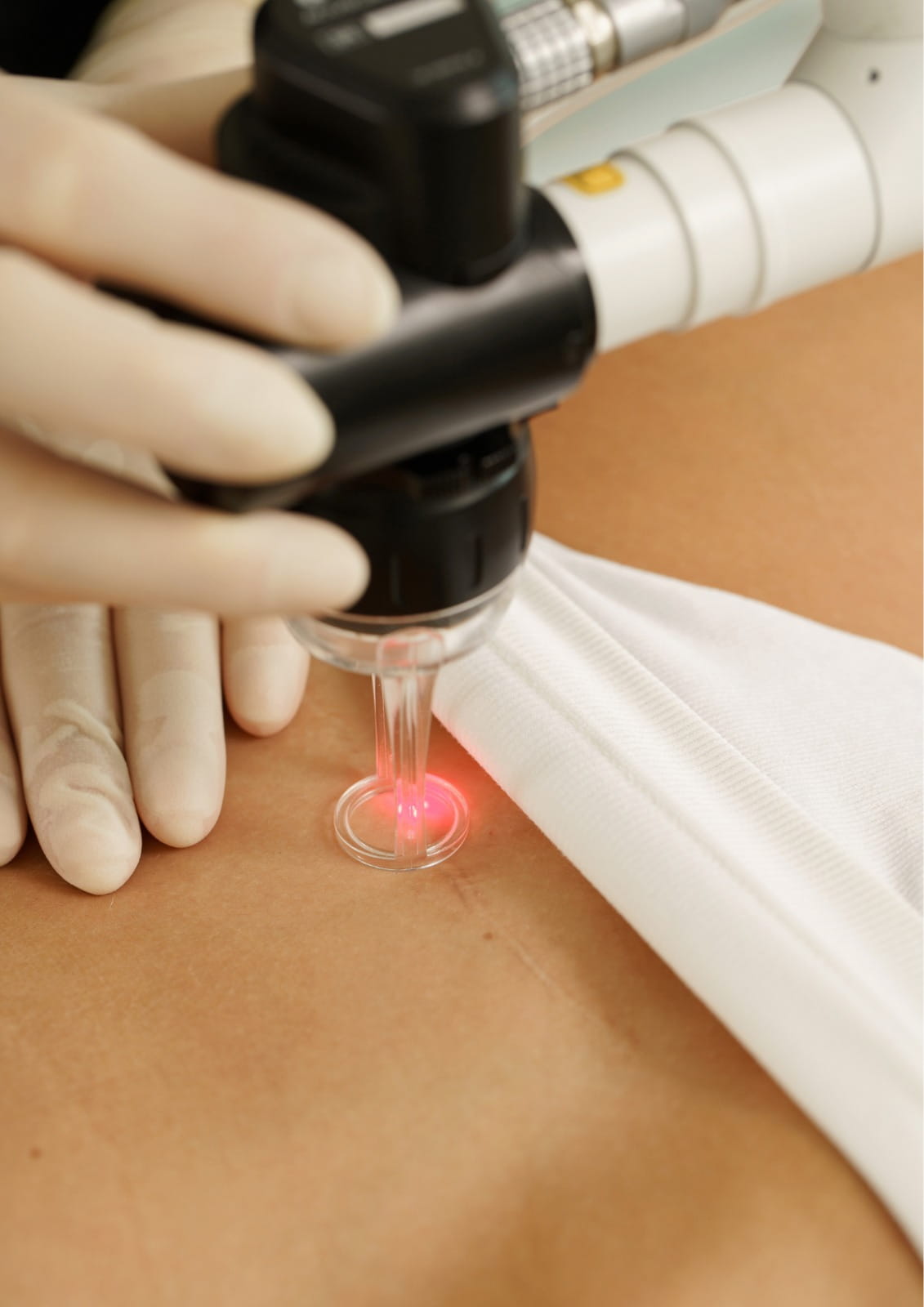 Scars removal in Dubai performed by specialists using advanced treatments to reduce scar appearance and improve skin texture.